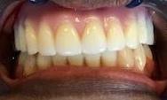 Close up of mouth after immediate denture, charlotte nc
