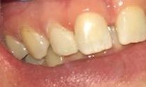 Close up of teeth after composite bonding, charlotte nc