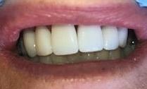 Close up of teeth after veneers and teeth whitening, charlotte nc