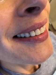 dental crowns after | charlotte nc