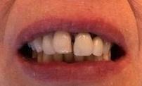 Photo of mouth before cosmetic bridge, charlotte nc
