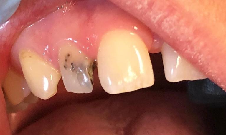 Close up of teeth before composite bonding, charlotte nc