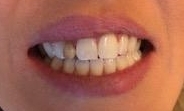 patient before implant and bridge | charlotte, nc