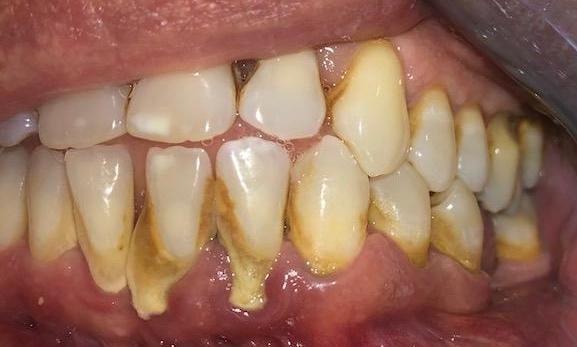 Close up of a mouth before a deep cleaning, charlotte nc