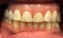 Patient before dental crowns | charlotte nc