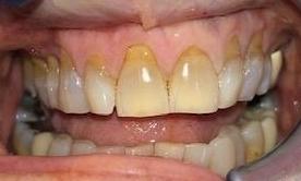 Close up of teeth before veneers and teeth whitening, charlotte nc