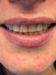 before dental crowns | charlotte nc