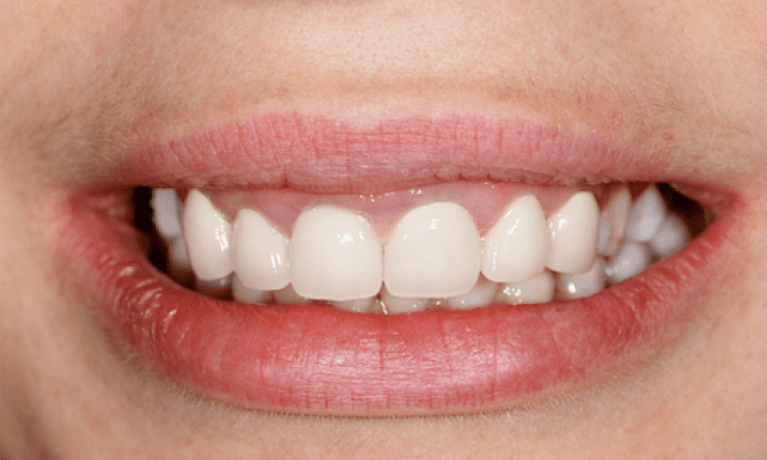 Teeth after teeth whitening, charlotte nc