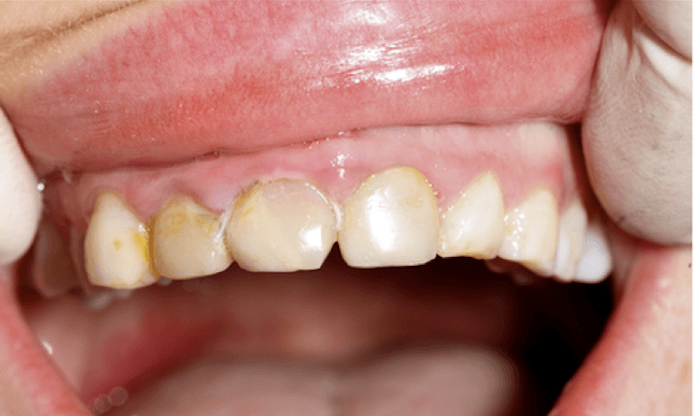 Teeth before teeth whitening, charlotte nc